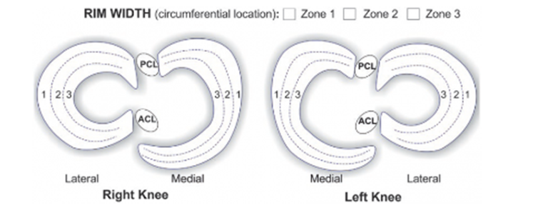 Drie zones in de meniscus