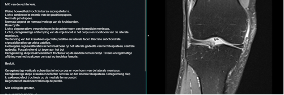MRI-voorbeeld van meniscusdegeneratie met kraakbeenlijden